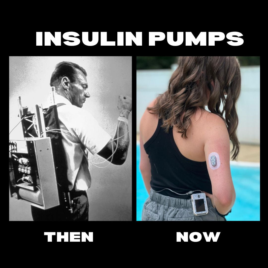 The History of Insulin Pumps - We have come so far-Pump Peelz